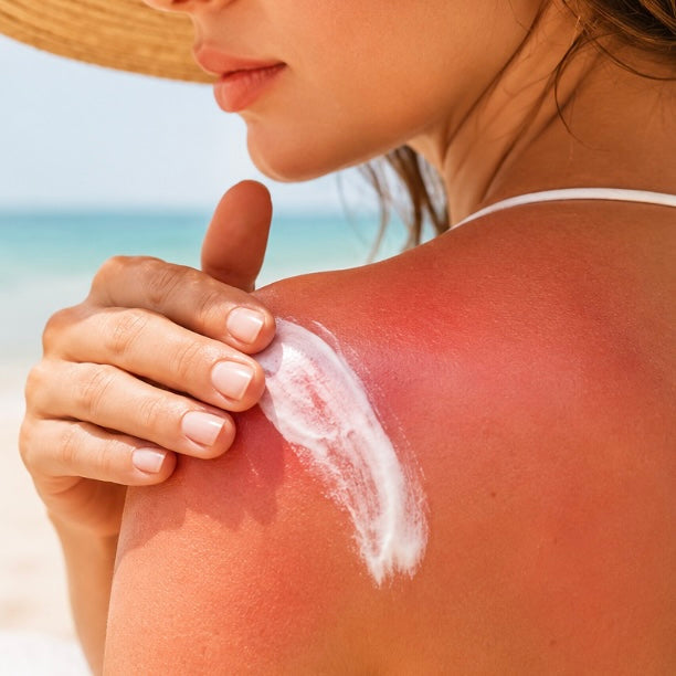 How to Heal a Sunburn Fast
