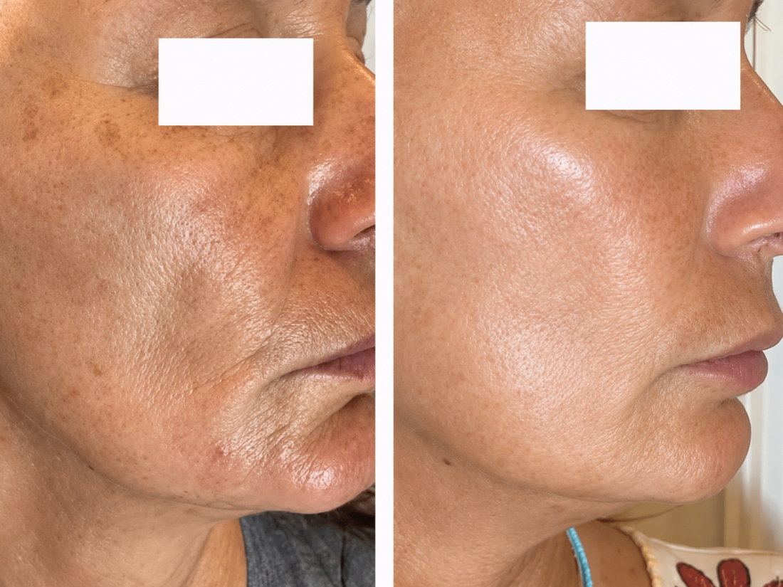 ✨ Post-Inflammatory Hyperpigmentation (PIH) ✨