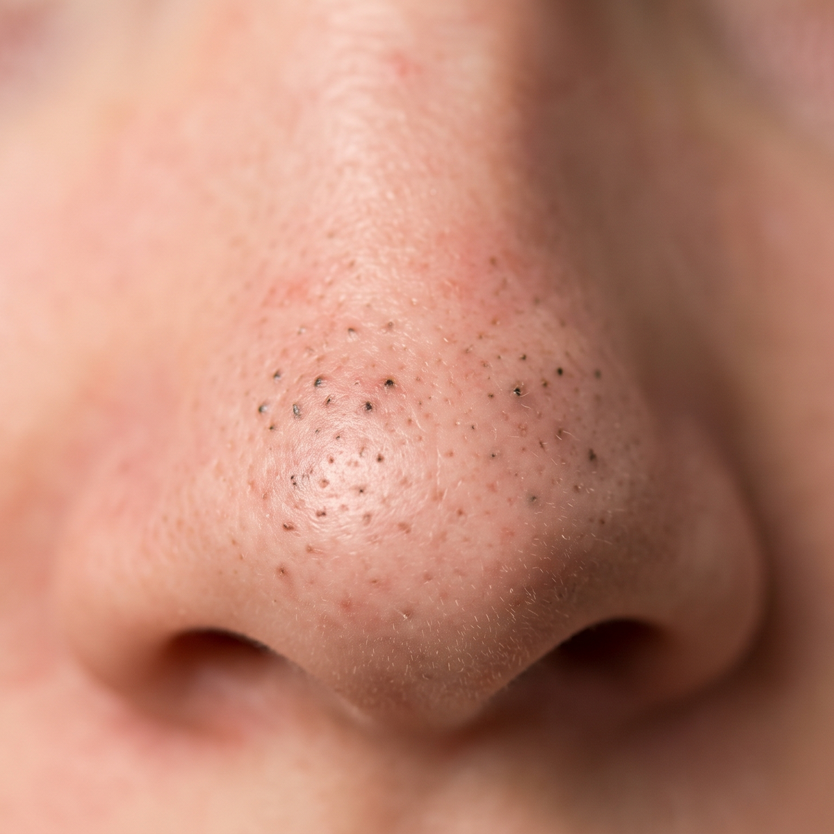 ✨ Say Goodbye to Clogged Pores! The Ultimate Guide to Salicylic Acid for Blackheads ✨