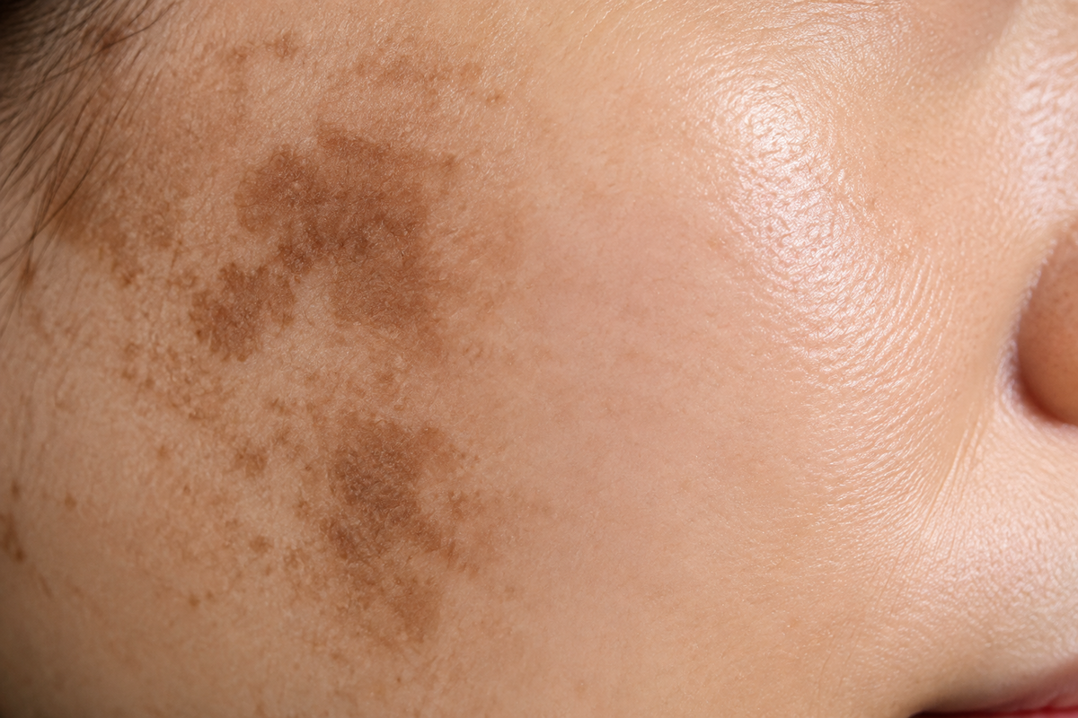 Kojic Acid for Hyperpigmentation: Does It Really Fade Dark Spots?