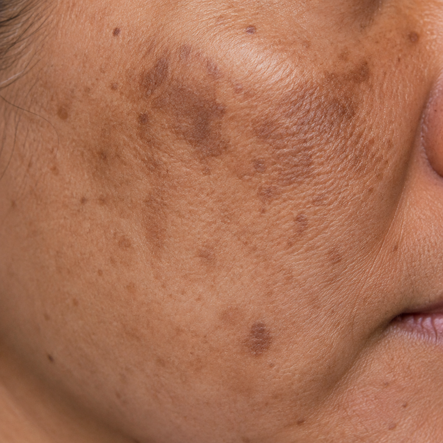 Mandelic Acid for Hyperpigmentation: Your Guide to Brighter-Looking Skin