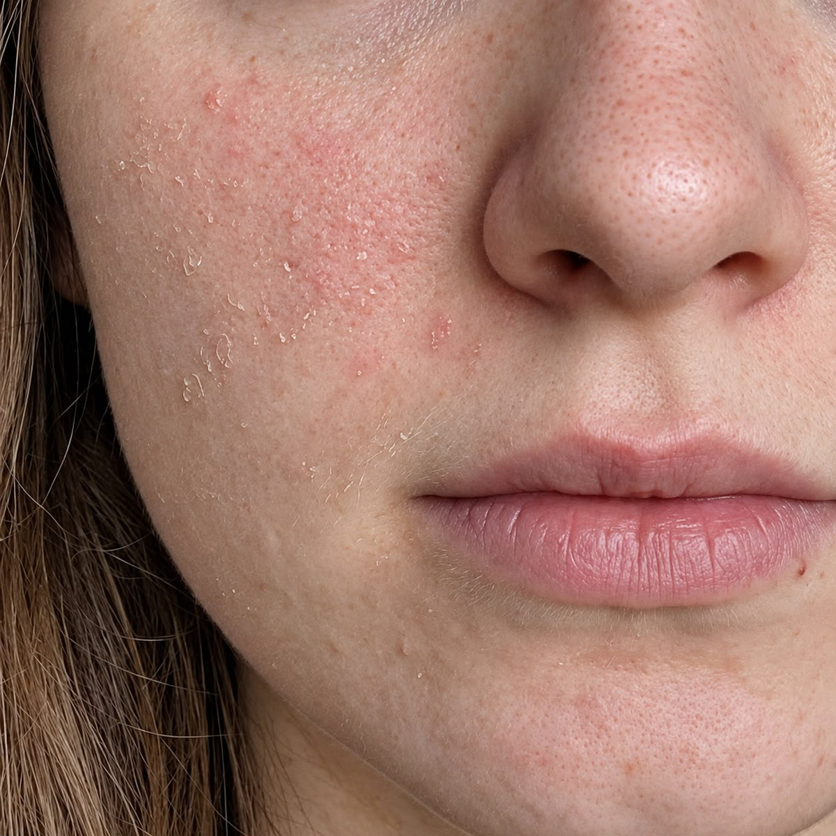 Dry Skin & Hydration