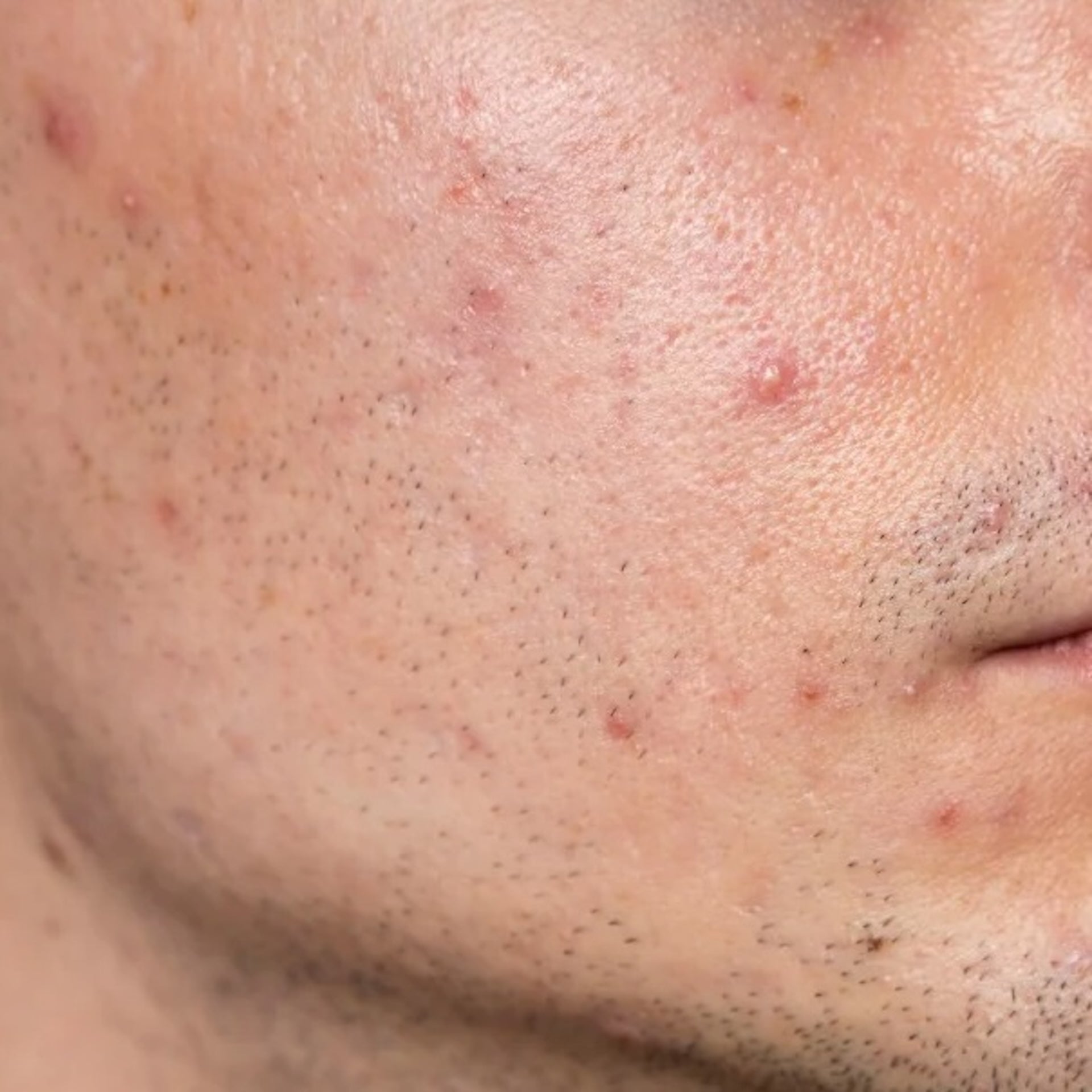 Oily Skin & Acne-Prone