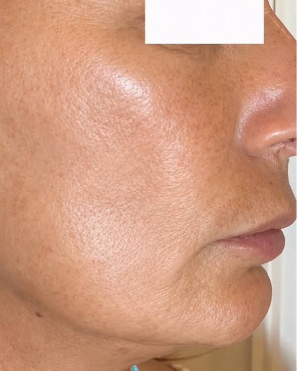 A side-by-side before-and-after style close-up of a person's lower face and neck, showing skin texture and tone improvement. The eyes are obscured by white blocks, and no product packaging or brand is visible.