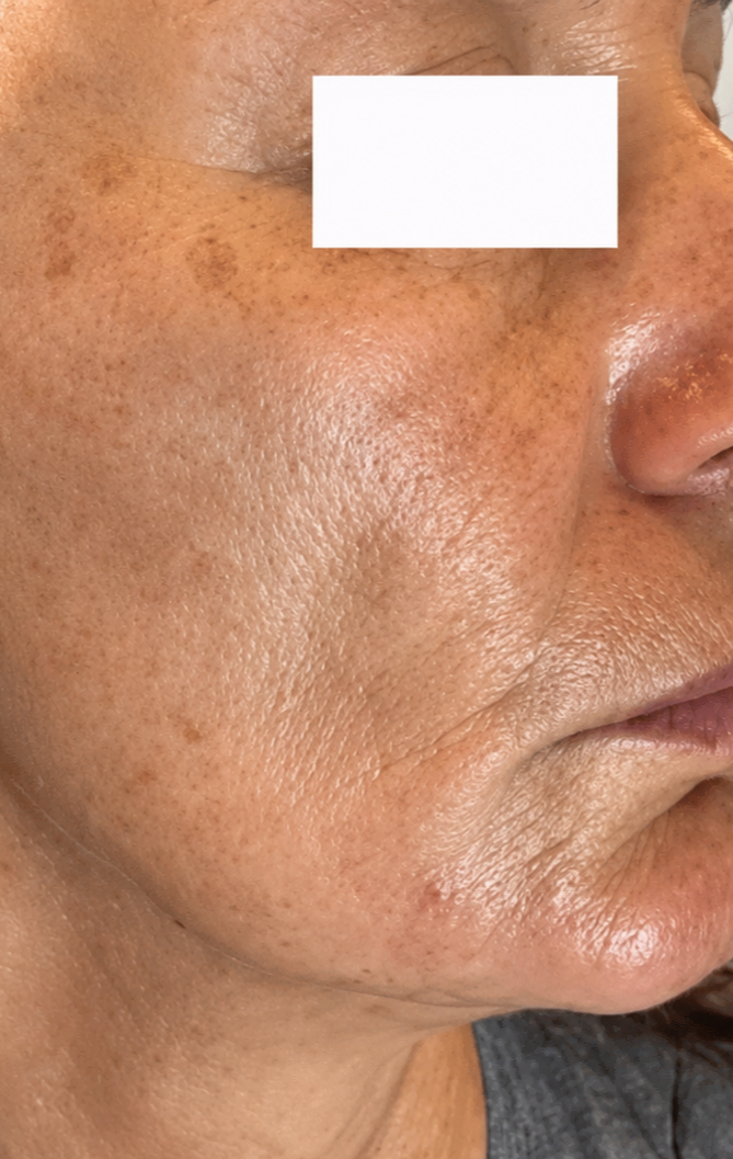 Professional Glycitric Peel 70% – 100 ml