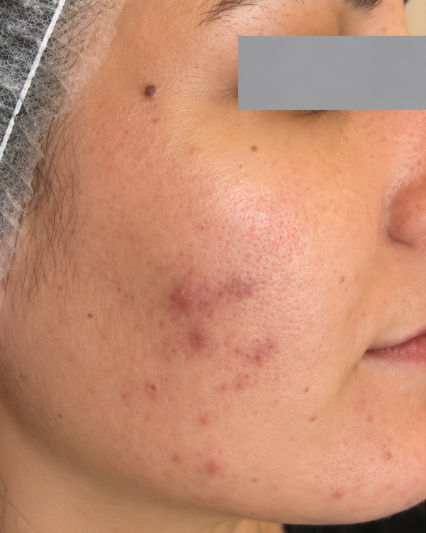Before-and-after side-by-side comparison of a woman's facial skin, showing acne and hyperpigmentation on the left panel and clearer, smoother skin on the right panel. The eyes are obscured with gray blocks.