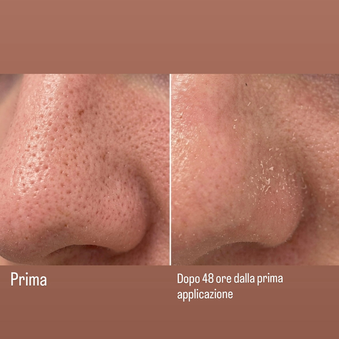 Salicylic & Mandelic Acid Peel